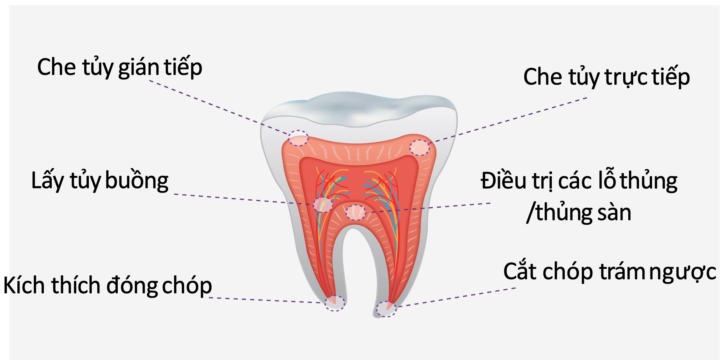 MTA trám bít ống tủy Endocem MTA Premixed Regular Maruchi 